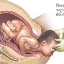 Nacimiento Vaginal después de Cesárea